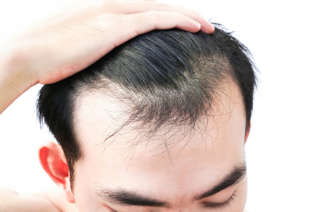 Man with thinning hair